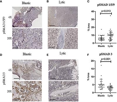 Targeting the BMP Pathway in Prostate Cancer Induced Bone Disease